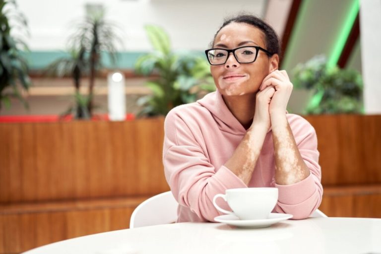 Mulher com vitiligo usando óculos e casaco rosa sentada próximo à uma mesa com xícara e pires brancos